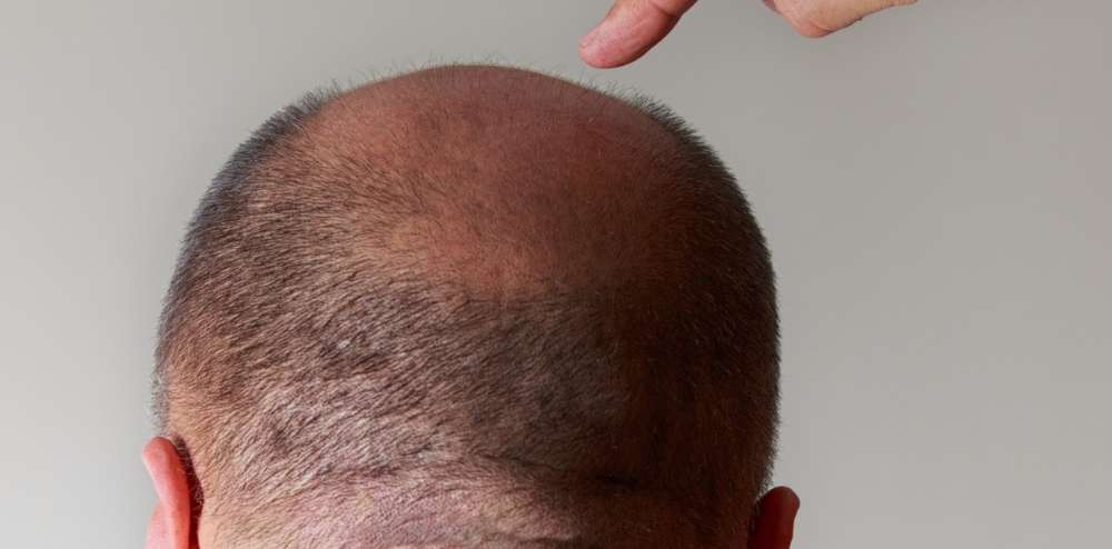 Hormone Effects on Hair Loss - Estevitalya Hair