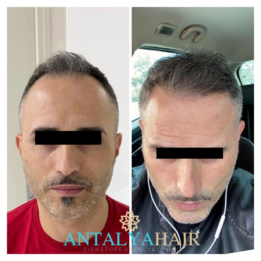 saç ekimi antalya öncesi sonrası