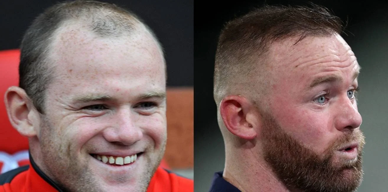 Did Wayne Rooney Go Through Hair transplant procedure