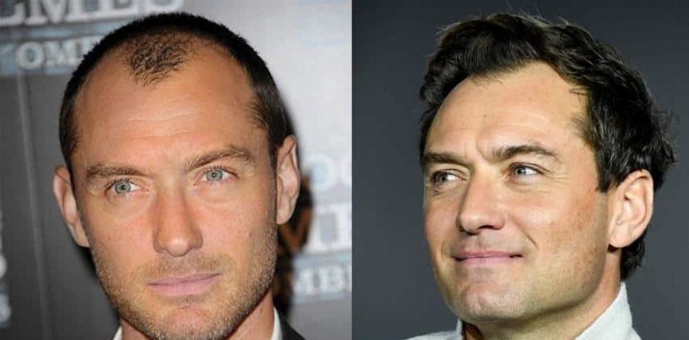 Jude Law Hair Transplant: Impact on His Life & Career - Estevitalya Hair